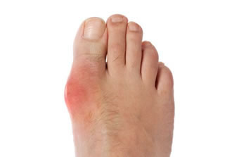 Gout in the Littleton, CO 80120 area